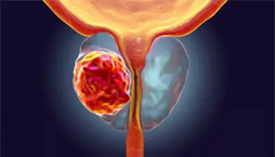 Cancro prostata, speranze di sopravvivenza con darolutamide Tumore della prostata